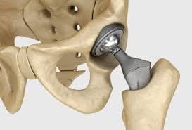 Carp tunnel syndrome