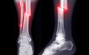Ankle Surgery